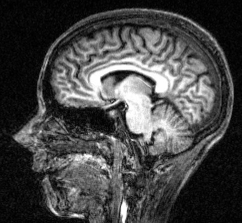 A picture of my brain.  Even I can see there is no tumour there!  Not as much grey matter as I would have hoped either. Hey ho